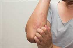 Global Atopic Dermatitis Drugs Market Facts