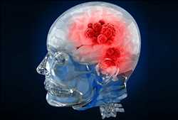 Global Brain Tumor Diagnosis And Treatment Market trend