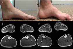 Global Charcot-Marie-Tooth Disease Type I Future Market Scope