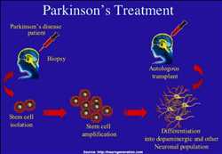 Global Parkinson’s Disease Treatment Market overview