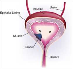 Global Urinary Tract Cancer Market demand