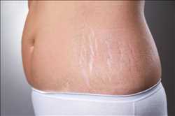 Global Stretch Marks Treatment Market Facts