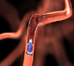 Global Thrombectomy Devices Market Landscape