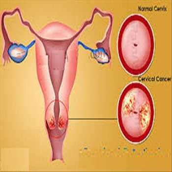 Cervical Dysplasia Market