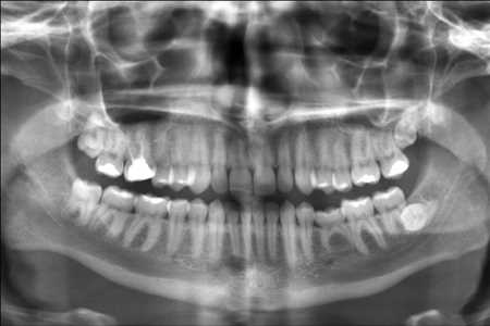 Dental X-Ray Market