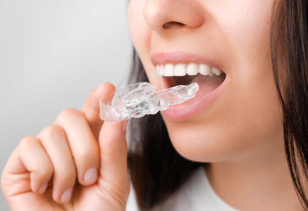 clear aligners market