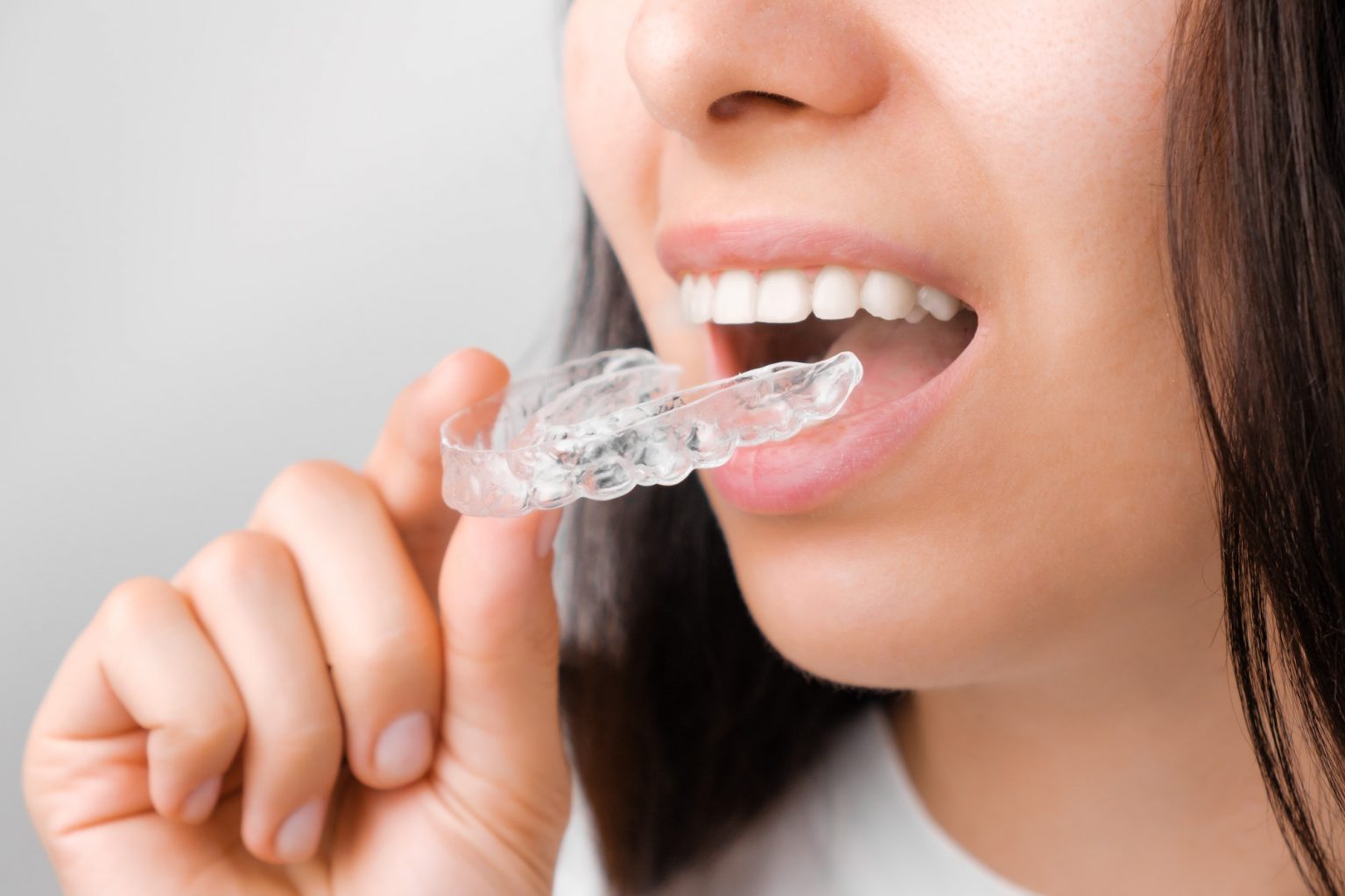 clear aligners market